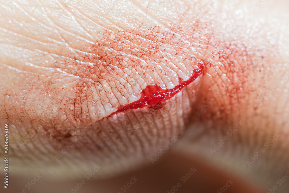 Fototapeta premium Injure on the finger