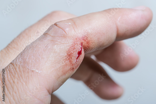 Bleeding wound - a cut on arm. An injure on the finger of a working man, closeup.