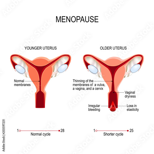 Menopause or climacteric. Younger and older women uterus