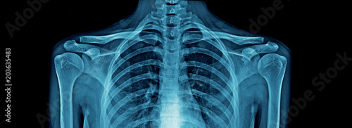 upper part of human body x-ray, high quality chest x-ray and part of spine and full AP of shoulder joint in blue tone for webpage, banner