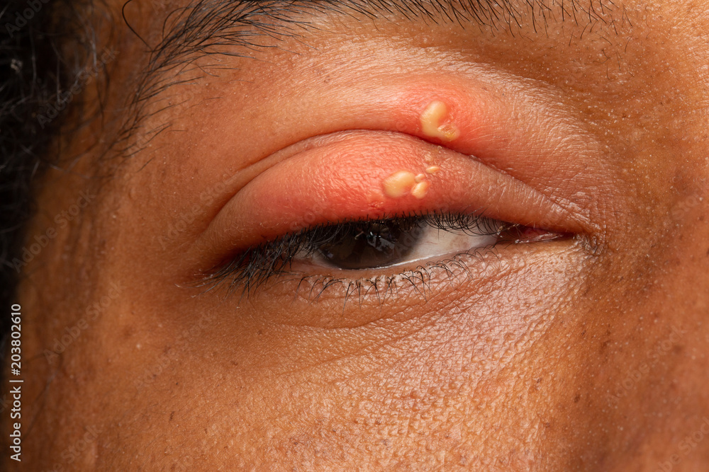 Herpes simplex in eyelid of african man foto de Stock | Adobe Stock