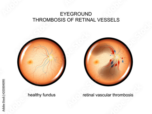 fundus. retinal vascular thrombosis photo