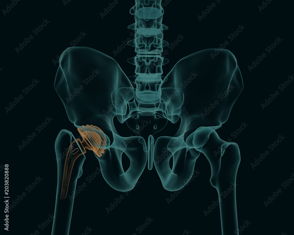 Human skeleton with a metal hip prosthesis concept arthroplasty 3d X-ray image - obrazy, fototapety, plakaty 