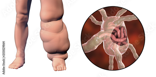 Leg of a person with elephantiasis, or lymphatic filariasis and close-up view of filariae worms blocking lymph node, 3D illustration photo