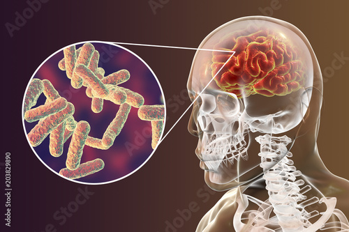 Bacterial brain infection medical concept, meningitis, encephalitis, 3D illustration