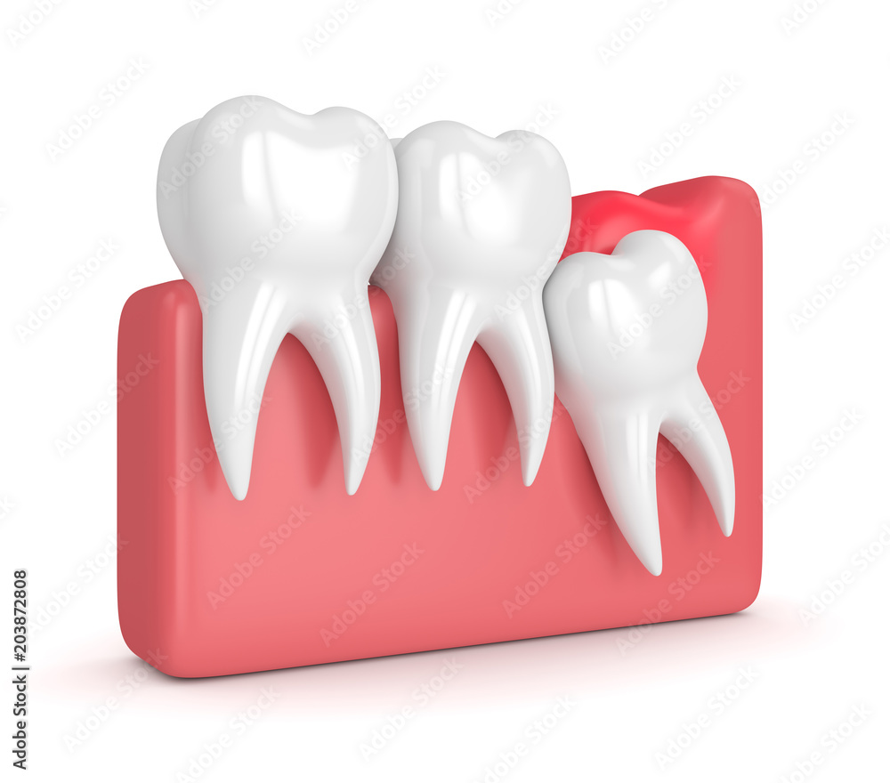 3d render of wisdom mesial impaction with pericoronitis 3d render of wisdom mesial impaction with pericoronitis