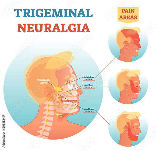 Trigeminal neuralgia medical cross section anatomy vector illustration diagram with facial neural network and pain areas.