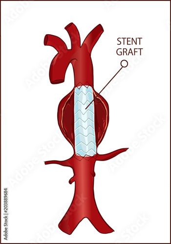 Vector - Thoracic (descending) aortic aneurysm and endovascular surgery
