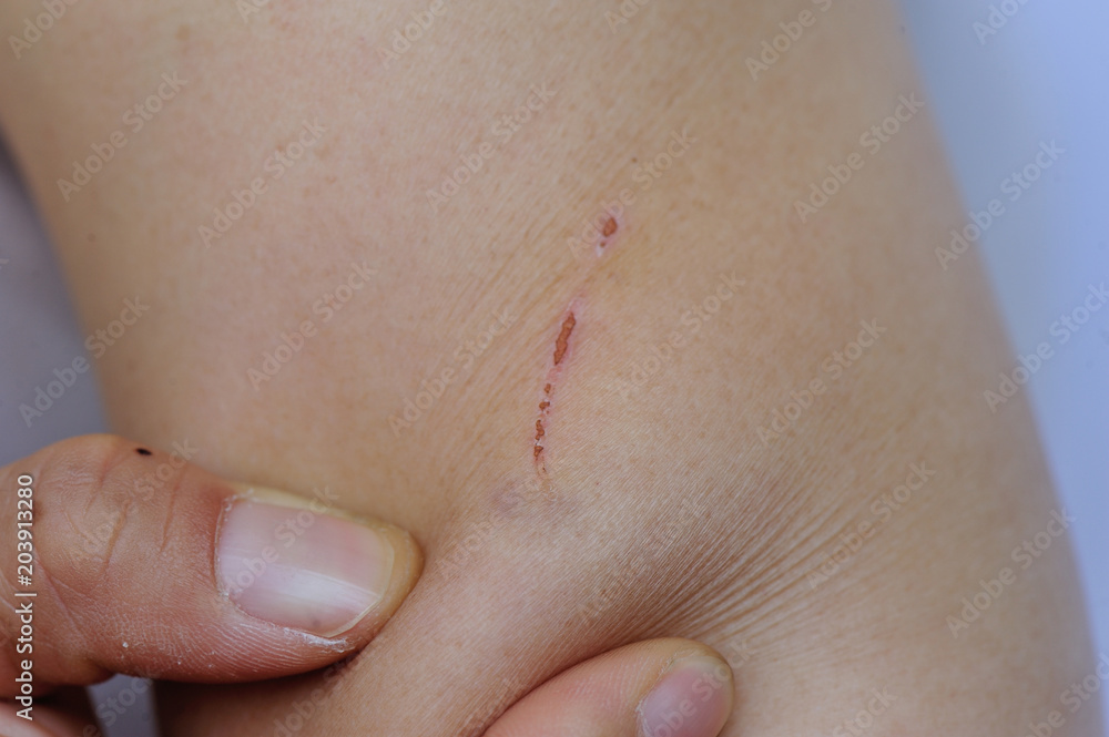 Fototapeta premium people with wounded arm holding in hand