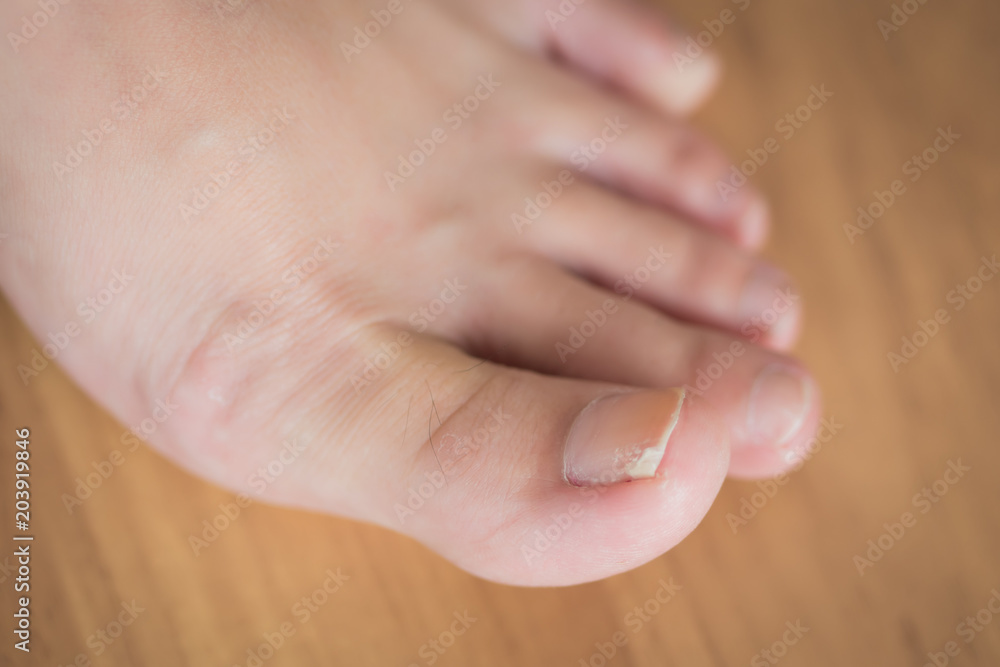 Wound On Foot That Won't Heal? See A Podiatrist Right Away