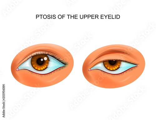 ptosis of the eyelid photo