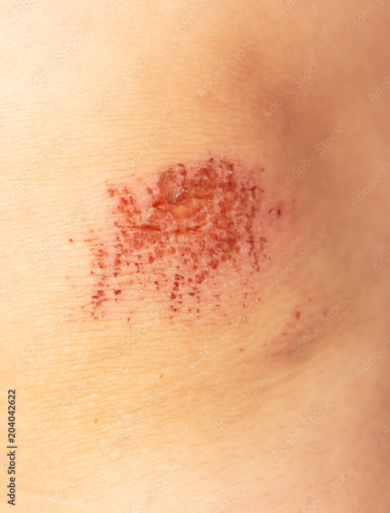 Fototapeta premium abrasion on the child's knee