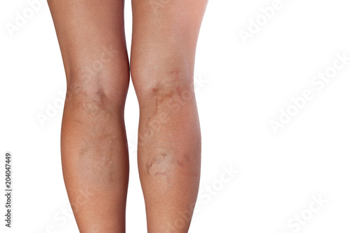 Varicose veins of woman legs