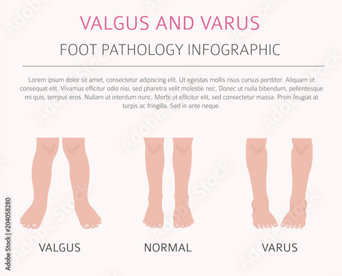 Foot deformation as medical desease infographic. Valgus and varus defect