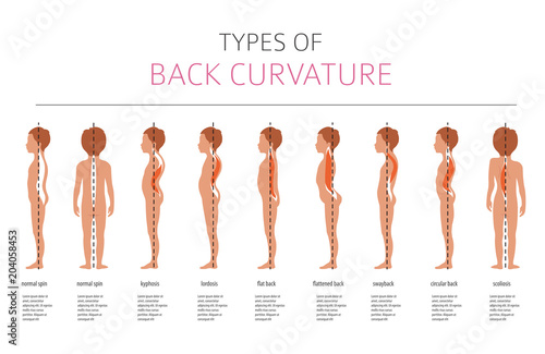 Types of back curvature. Medical desease infographic photo