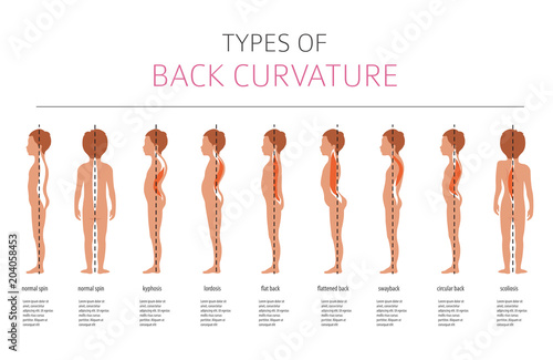 Types of back curvature. Medical desease infographic