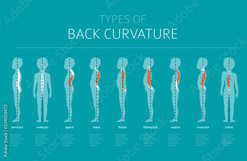Types of back curvature. Medical desease infographic