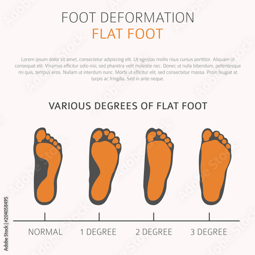 Foot deformation as medical desease infographic. Causes of Flat foot