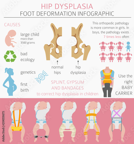 Foot deformation types, medical desease infographic. Hip dysplasia in children