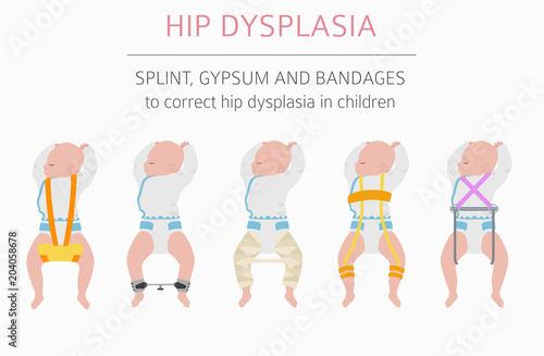 Foot deformation types,  medical desease infographic. Hip dysplasia in children