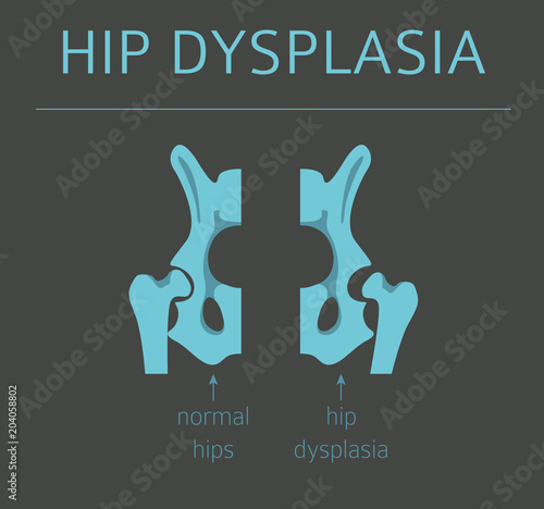 Foot deformation types,  medical desease infographic. Hip dysplasia in children