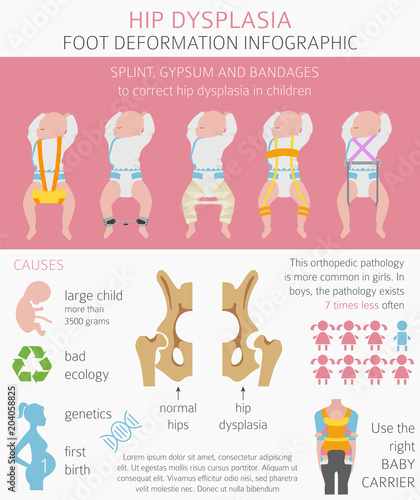 Foot deformation types,  medical desease infographic. Hip dysplasia in children