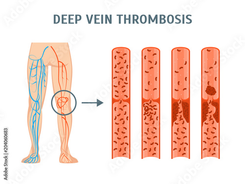 Cartoon Deep Vein Thrombosis Infographics Card Poster. Vector