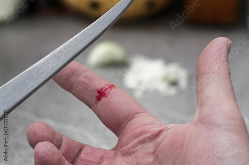 In den Finger geschnitten beim Zwiebel schneiden