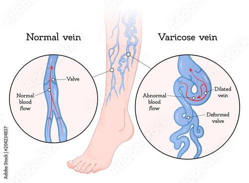 Varicose veins poster