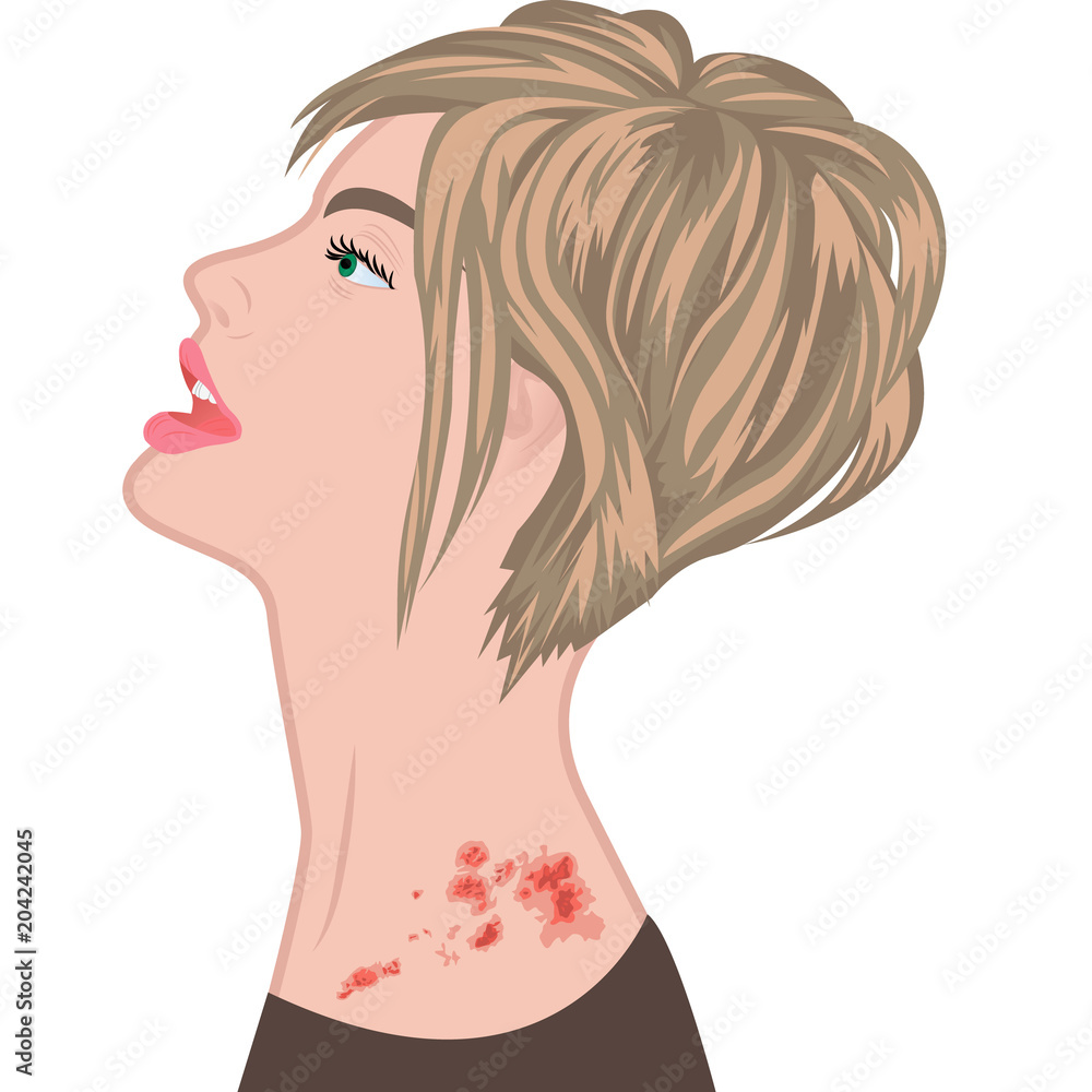 Shingles on a woman shoulder. varicella zoster vector illustration Shingles on a woman shoulder. varicella zoster vector illustration