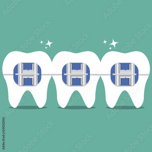 Vector teeth braces flat illustration