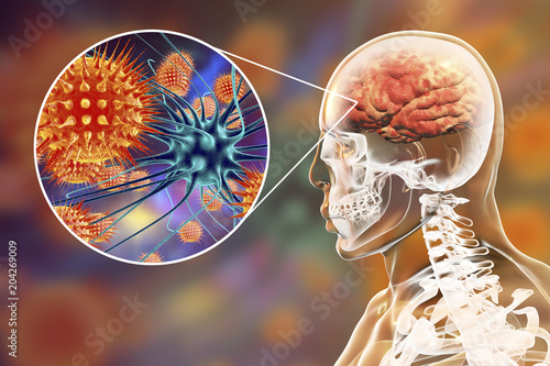 Tableau sur toile Viral meningitis and encephalitis, medical concept, 3D illustration showing brai