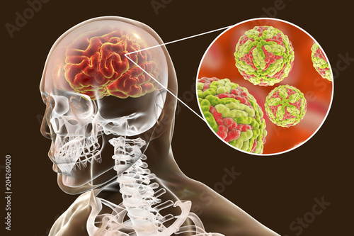 Japanese B encephalitis, medical concept, 3D illustration showing brain infection and close-up view of Japanese encephalitis viruses in the brain photo