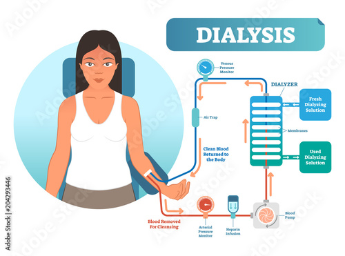 Dialysis medical procedure system vector illustration diagram. Filtering blood in case of kidney malfunction.