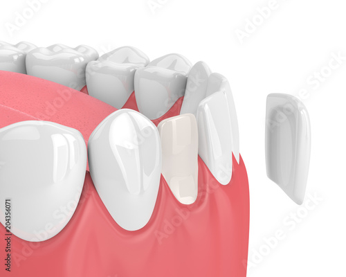 3d render of teeth with veneer photo