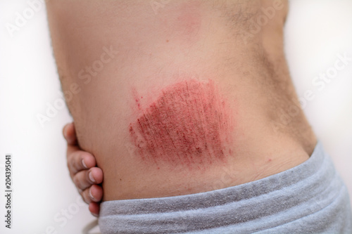 close-up bleeding wound or bruised hand on the elbow of a man on a white isolated background