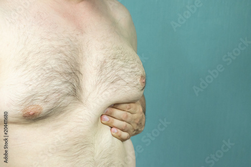 fat white middle-aged man with Gynecomastia, enlarged breast close-up
