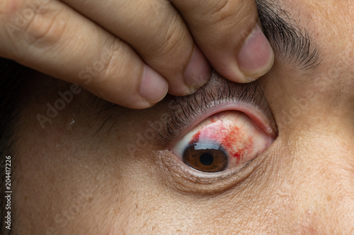 Blood in the eye from a subconjunctival hemorrhage usually disappears within a week or two.Human eye and blood close up.