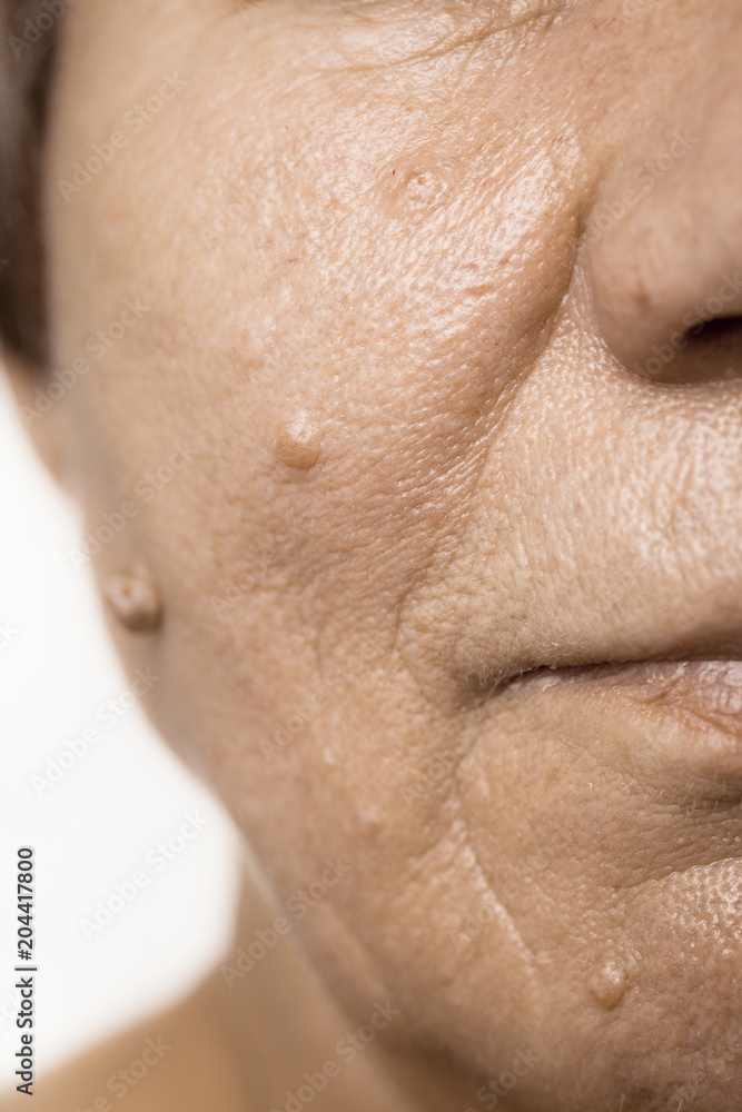 Elderly pensioner female, dermal fibroma closeup. Elderly pensioner female, dermal fibroma closeup.