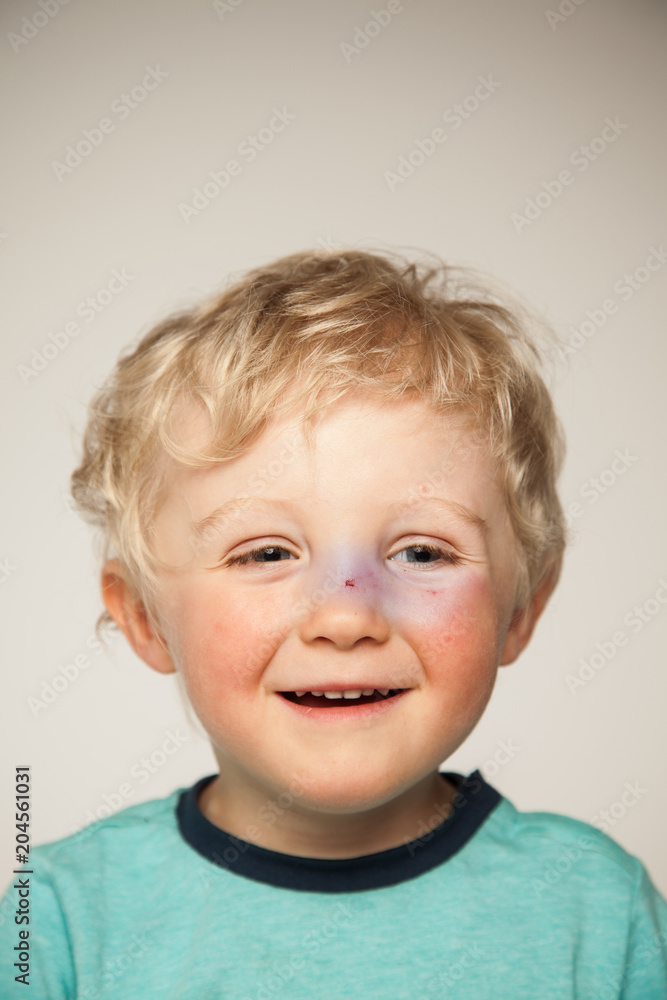 Lachen trotz gebrochener Nase Lachen trotz gebrochener Nase