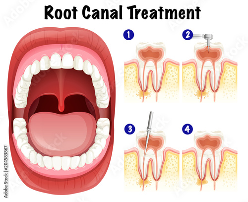 Dental Vector of Root Canal Treatment