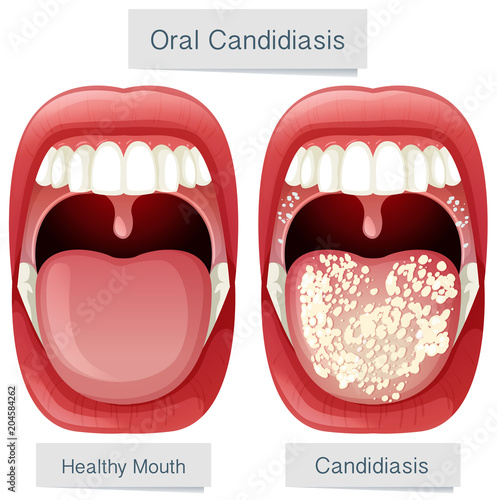 Human Mouth Anatomy Oral Candidiasis photo