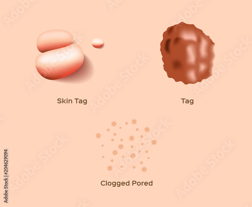 skin tag and clogged pored vector