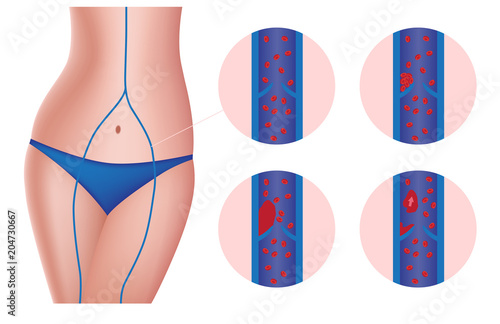 vein thrombosis embolus vector / arteriosclerosis