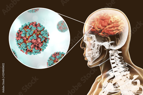 Venezuelan equine encephalitis, medical concept, 3D illustration showing brain infection and close-up view of Venezuelan equine encephalitis viruses