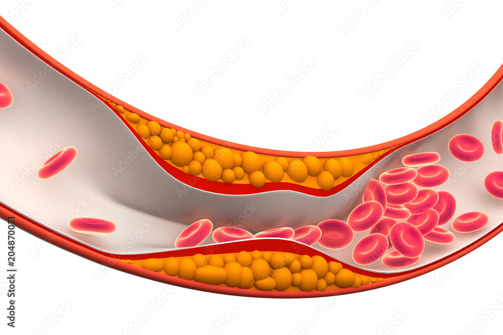 Cholesterol plaque in artery.3d render Cholesterol plaque in artery.3d render