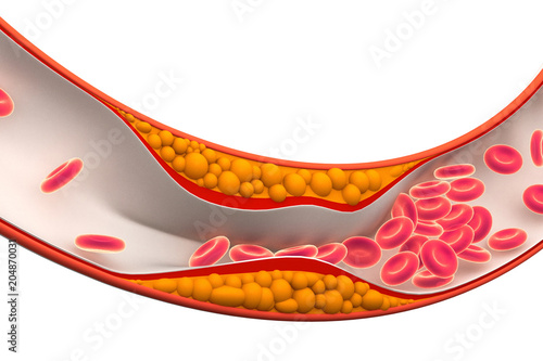Cholesterol plaque in artery.3d render photo