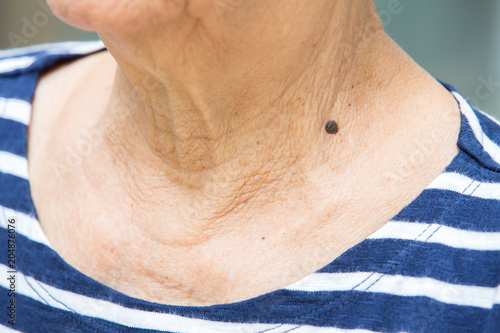 Black mole on senior woman's neck, Medicine, Close up