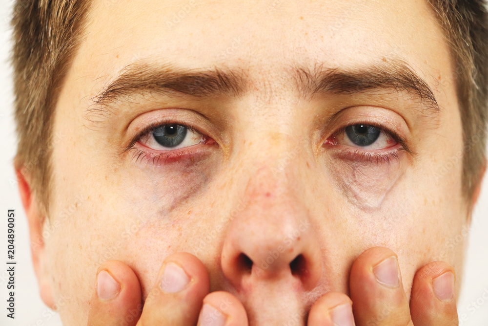 Conjunctivitis, tired eyes, red eyes, eye disease Stock Photo | Adobe Stock