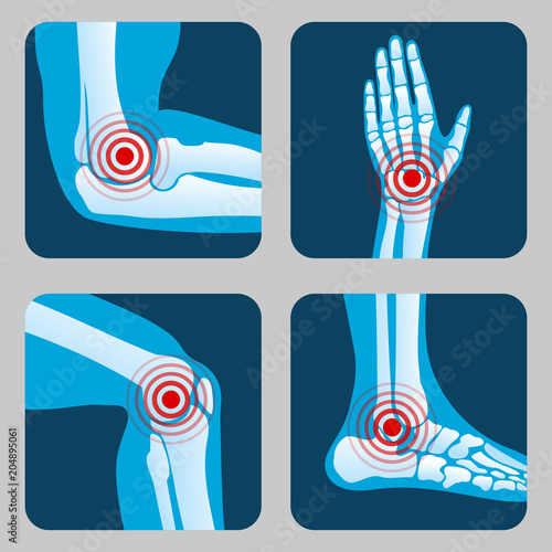 Human joints with pain rings. Arthritis and rheumatism infographic. Medical app vector buttons